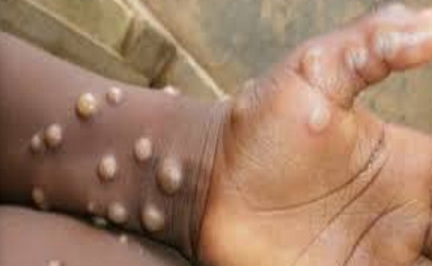 CARICOM nationals urged to be vigiliant against spread of mpox virus